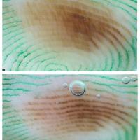 Oblique dermoscopy with inkThe ink helped…