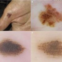 Peas and the podLesion A/B is melanoma with chaos…