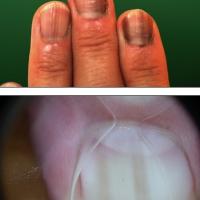 Benign longitudinal melanonychia…