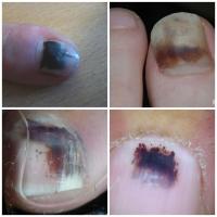 Four cases of subungual haematomaEven in the top…