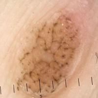 Dermoscopic image of previous lesionIn palpable…