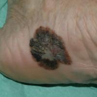 Acral lentiginous melanomaCopied with kind…