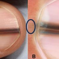 Nail matrix melanomaWhile the line may be…