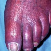 
	Acrocyanosis