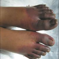 
	Acrocyanosis