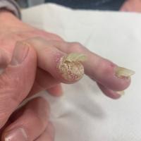 Acrodermatitis continua of Hallopeau
Copied with…