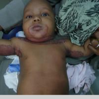 
	Acrodermatitis enteropathica
