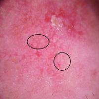 An actinic keratosis with circles&nbsp;Copied…