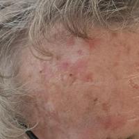 Actinic keratosesCopied with kind permission from…