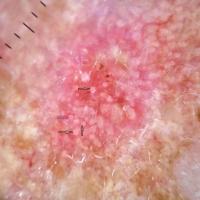 Dermoscopic appearance of previous figureA…