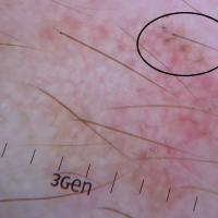 Partially pigmented AK with triangular areas of…