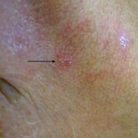 Actinic keratosis&nbsp;Evidence of surrounding…