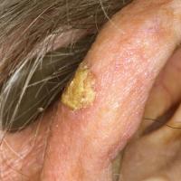 
	Actinic keratosis with a lot of surface scale…