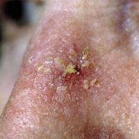 
	Actinic keratosis on nose