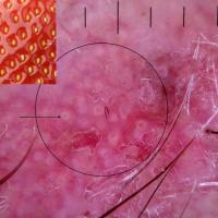 Actinic keratosis - dermoscopic appearanceLesions…