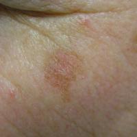 Pigmented actinic keratosis lateral and inferior…