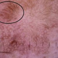 Dermoscopic appearance of previous figureEnlarged…