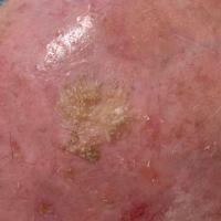 Follicular AKThese are less likely to respond to…