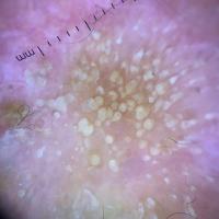 Dermoscopic appearance of previous figureCopied…