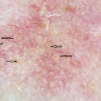 Dermoscopic appearance of previous figureHair…