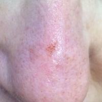 Pigmented actinic keratosis - rough to…