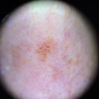 Dermoscopic image of previous figureMultiple…