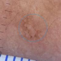 Pigmented actinic keratosisBrown triangular areas…