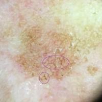 Dermoscopic appearance of previous…