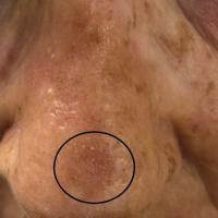 Pigmented actinic keratosis - rough white scale…