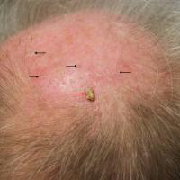 A hyperkeratotic actinic keratosisThis patient…
