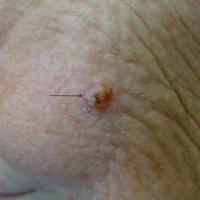 Well-differentiated SCCThe clues to the diagnosis…