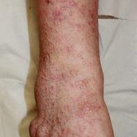 
	Actinic prurigo - same patient as figure 2