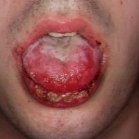 
	SJS affecting the oral mucosa

	Copied with…