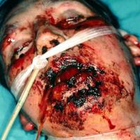 
	TEN with severe mucosal involvement

	Copied…