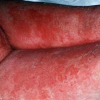 
	Same patient as figure 5

	Confluent erythema…
