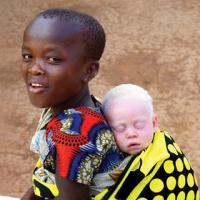 
	Oculocutaneous albinism

	Sadly, in many parts…