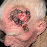 
	Oculocutaneous albinism and basosquamous…