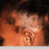 
	Traction alopecia

	Retained hairs along the…