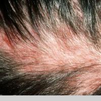 
	Follicular mucinosis&nbsp;