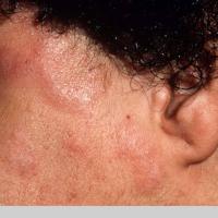 
	Follicular mucinosis&nbsp;