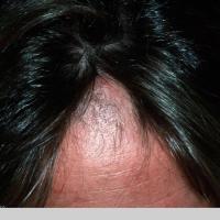 
	​Trichotillosis

	Different hair lengths