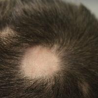 
	Alopecia areata
