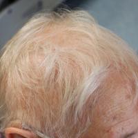 
	Anagen effluvium caused by tamoxifen