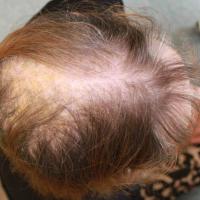 
	Telogen effluvium secondary to thyrotoxicosis 