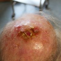 
	Erosive pustular dermatosis of the scalp

	This…