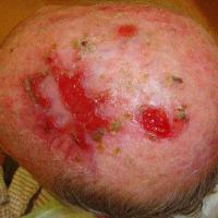 
	Erosive pustular dermatosis of the…