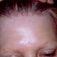 
	Frontal fibrosing alopecia - loss of hair front…