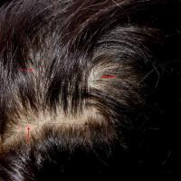 
	Iron deficiency anaemia

	This young lady had…