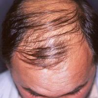 
	Male pattern alopecia&nbsp;
	
	Copied with kind…