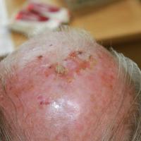
	Same patient as previous - post-treatment with…